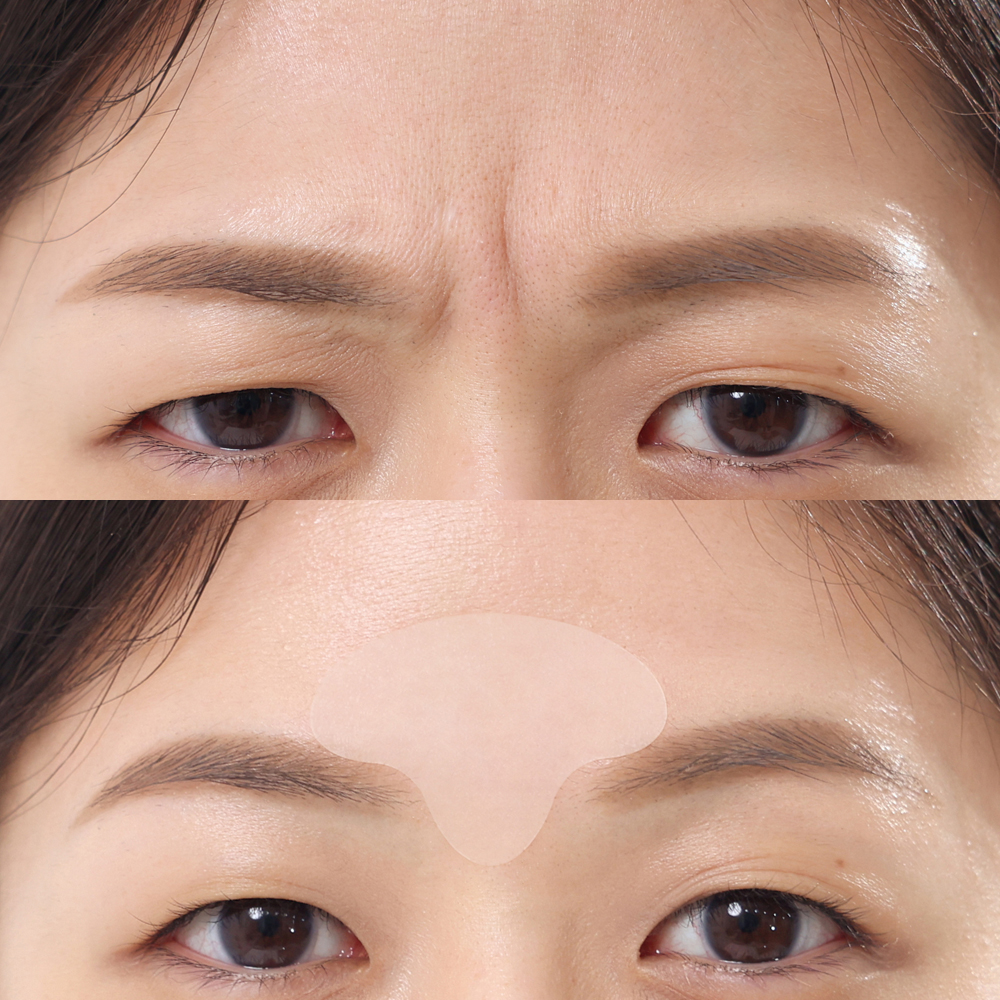 매드포코스 팔자주름패치 2매(72패치)/ 지퍼타입