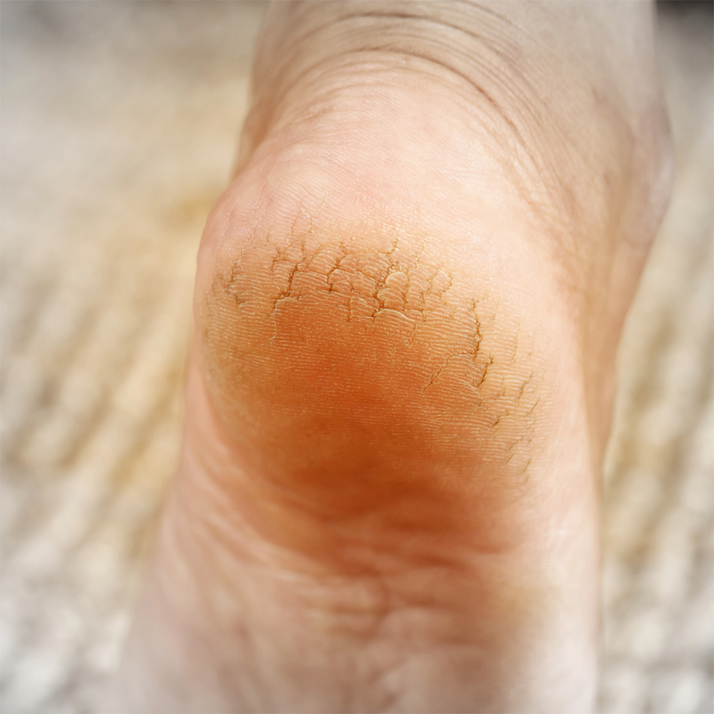 올리브영 발 뒤꿈치 굳은살 갈라짐 발바닥 유리아크림 고운 각질연화제 풋크림 유레아 각질제거 보습