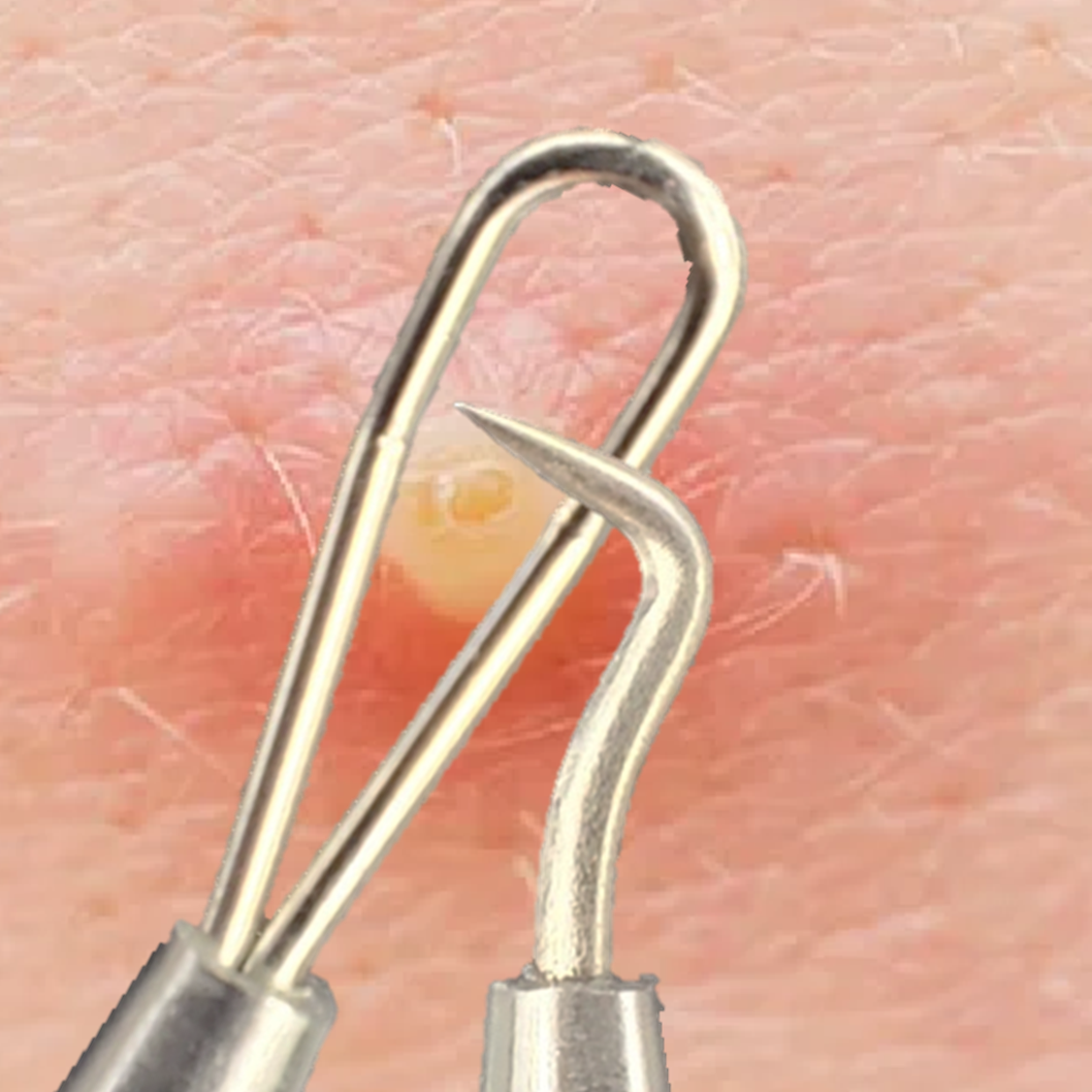 의료용 여드름 압출기 압출바늘 핀셋 얼굴 피지압출기 셀프제거 제거기 비립종 짜는도구